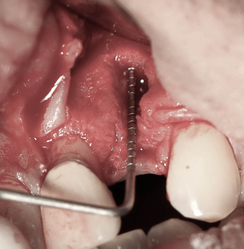 Implant-7-005