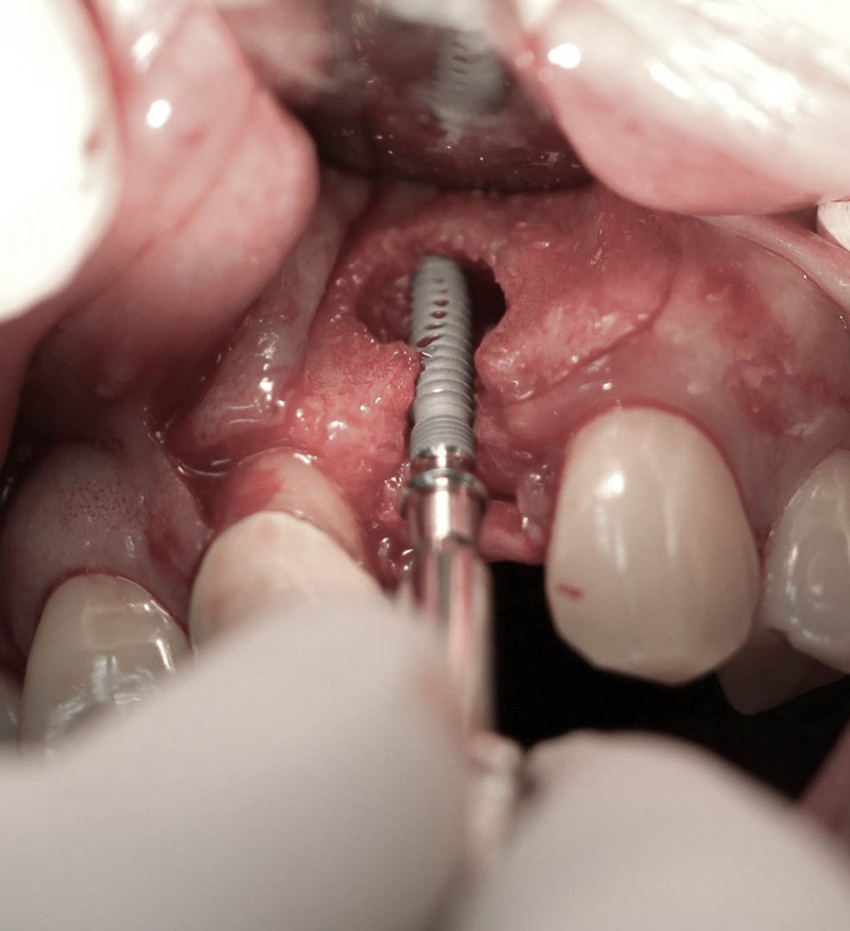 Implant-7-007