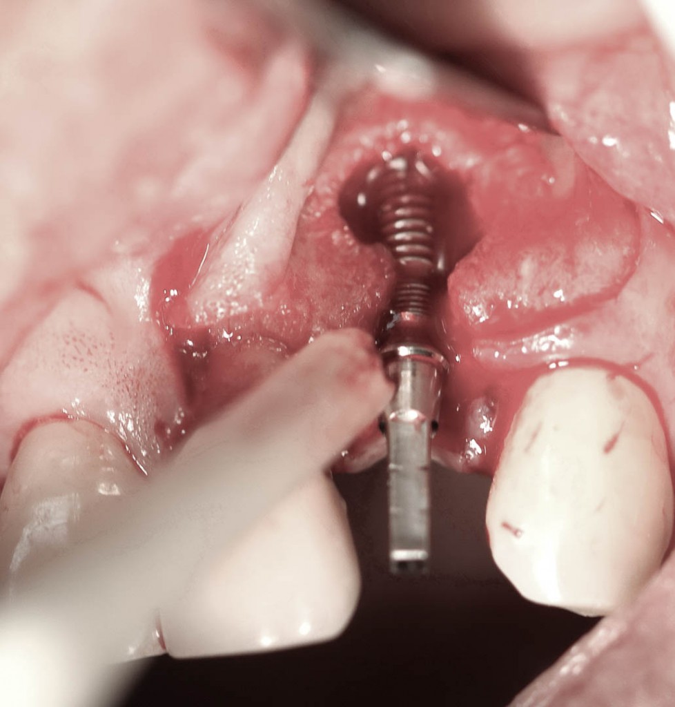 Implant-7-008