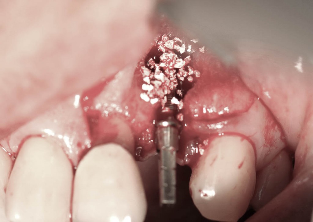 Implant-7-009