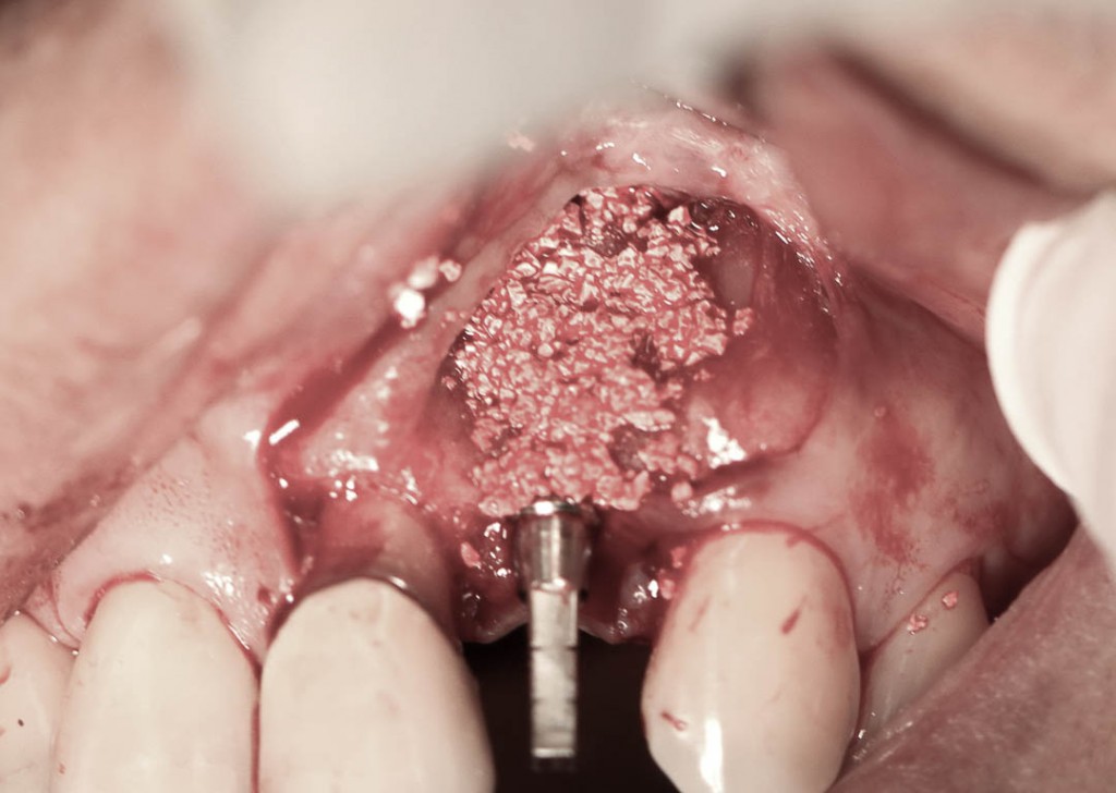 Implant-7-010