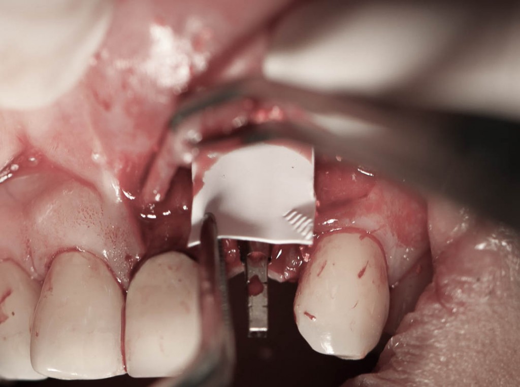 Implant-7-011