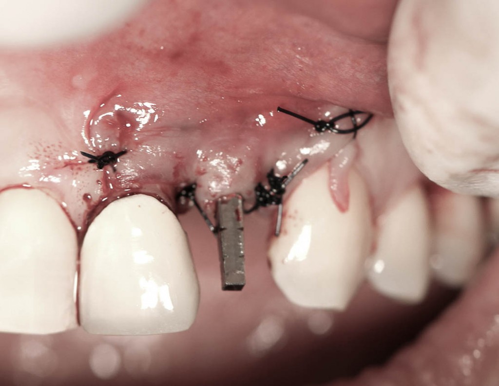 Implant-7-012